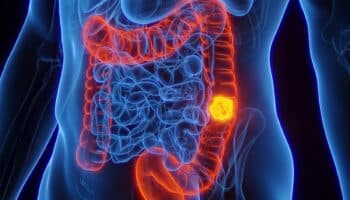 Incrementan en México casos de cáncer colorrectal en jóvenes: UNAM