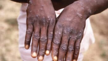 ¿Hay rebrote de la viruela del mono en África?