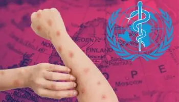 OMS asegura que sabe cómo 'eliminar por completo' la transmisión de mpox en Europa