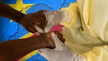 La República Democrática del Congo registra 548 muertes de mpox