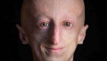 Muere a los 28 años Sammy Basso; el científico con envejecimiento prematuro