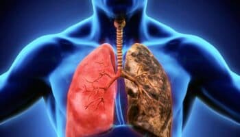 Hay que cambiar la perspectiva de abordaje del cáncer de pulmón: Jefe oncológico del INER