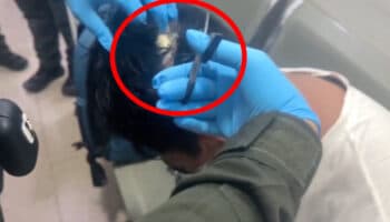Narcopeluca: intentó contrabandear droga bajo un tupé en Colombia