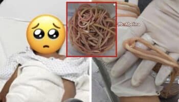 Un niño llega con dolor abdominal y le extirpan 142 lombrices del intestino en Chiapas