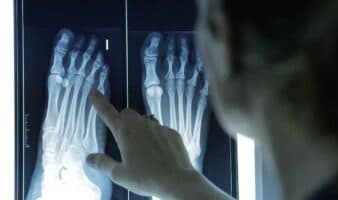 Podólogos: 60% de los adultos padece deformidades en los dedos de los pies