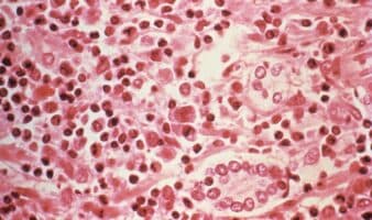 Moderna anuncia trabajos para desarrollar una vacuna contra el hantavirus